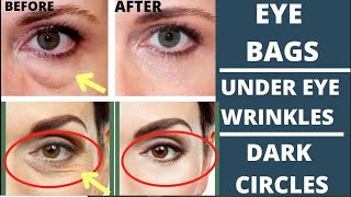 EYE REJUVENATION  ANTIAGING EXERCISES FOR EYE WRINKLES DARK CIRKLES PUFFY EYELIDS EYE BAGS [upl. by Michaella]