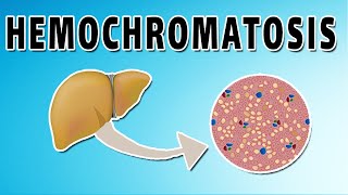 Hemochromatosis [upl. by Rosenstein]