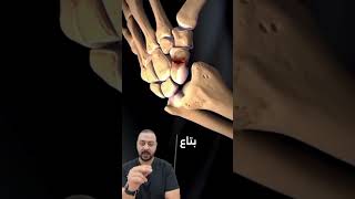 كسور العظمه الزورقيه ، scaphoid fracture surgeon anatomictherapy ترند orthopedicsurgeon [upl. by Yelyac952]