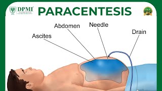 Paracentesis Peritoneal Fluid Analysis Or Ascitic Fluid Analysis Ascites  Causes amp Symptoms [upl. by Calida]