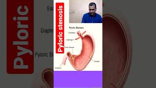 pyloric stenosis to watch full video click on link given in comments section [upl. by Idnil792]