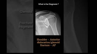 Shoulder Anterior dislocationglenoid fracture AP 109 Trauma XrayUpperlimbG1radiologychannel007 [upl. by Shell]