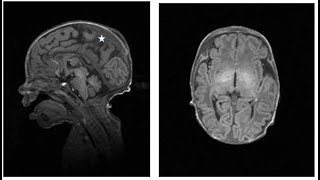 Megalencephaly and Epileptic Encephalopathy Bad luck or a common pathway [upl. by Uriisa]