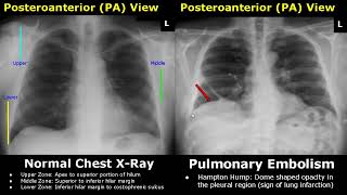 Chest XRay Lung Normal Vs Abnormal Image Appearances Part 2  Pleural EffusionPneumothorax PA CXR [upl. by Waters]