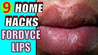 How to remove Fordyce Spots  Fordyce Spots Removal with NEEDLE METHOD Tutorial [upl. by Odessa]