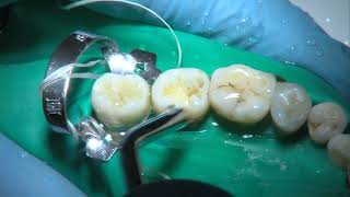 OPERATORIA DENTAL Y ENDODONCIA TÉCNICAS Y MATERIALES7 COMPOSITE CAVIDAD DE CLASE I [upl. by Aubrie]