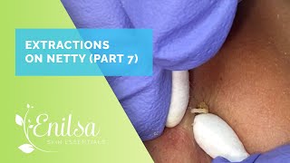 Extracting Blackheads on Netty  Seventh Treatment [upl. by Anilorac]