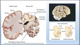 Neurological Disorders [upl. by Johna]