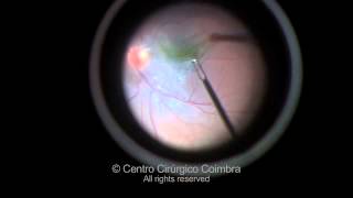 Epiretinal Membrane in Children [upl. by Arathorn569]