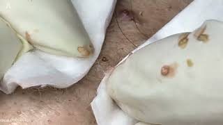 Big Cystic Acne Blackheads Extraction Blackheads amp Milia Whiteheads Removal Pimple Popping [upl. by Leuneb]