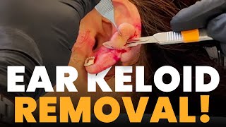 EAR KELOID REMOVAL [upl. by Dimo]