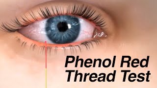 Phenol Red Thread Test for Dry Eyes [upl. by Grondin535]