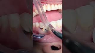 Composite restoration dentist dentista dental teeth [upl. by Moina]