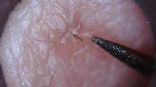 Multiple hair follicle removal [upl. by Irovi]