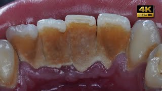 Deep Cleaning With HEAVY Tartar Build Up At The Dentist [upl. by Ailsa565]