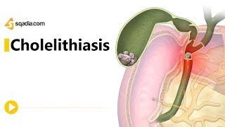 Cholelithiasis II  Gastroenterology Medicine Animation  Medical VLearning [upl. by Ghiselin502]