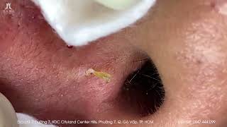 Big Cystic Acne Blackheads Extraction Blackheads amp Milia Whiteheads Removal Pimple Popping [upl. by Avis34]