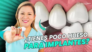 ¡Descubre la Solución Secreta si Tienes Poco Hueso para Implantes Dentales [upl. by Millan]