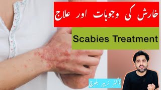 Scabies ka ilaj in Urdu  Scabies Treatment  Kharish khatam karne ka Tarika  Urdu  खुजली का इलाज [upl. by Gunas]