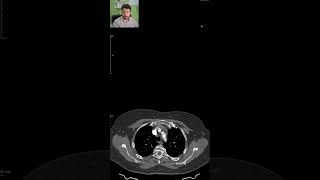 PAIN and MISSING PULSE in the left arm  CT SCANS Ep 15 ctscan medicalimaging angiography [upl. by Lachlan]