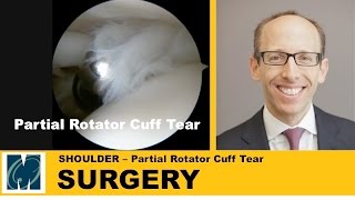 Shoulder Pain  Partial Rotator Cuff Tears [upl. by Zahara]