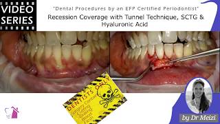 Recession Coverage with Tunnel Technique SCTG amp Hyaluronic Acid [upl. by Oates]