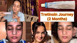 2 Month RetinolTretinoin Journey✨ [upl. by Nera]