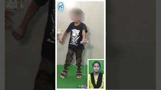 Dyskinetic cerebralpalsy child managed by therapy amp brace at trishla [upl. by Ycnuahc857]