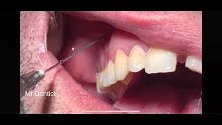 Complicated Tooth Extraction [upl. by Anderer]