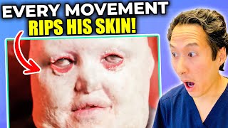 Plastic Surgeon Reacts to Man Whose Skin Falls Apart EXTREME Bodies Explained [upl. by Misab403]