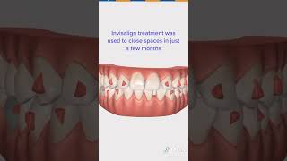 Invisalign before and after  Invisalign time lapse  Invisalign process  Dr Yazdan [upl. by Quincy832]