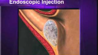 Vesicoureteral Reflux Education Video [upl. by Ingunna]