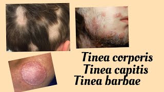 Tinea capitis  tinea barbae  tinea corpora in hindi  Fungal infections in hindi [upl. by Rotman]