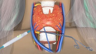 3D Medical animation Parathyroidectomy Cure with Minimally Invasive surgery [upl. by Patsy449]