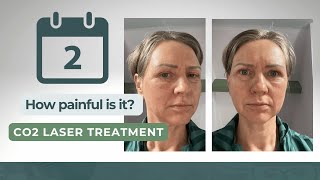 How Painful Is Day 2 After Co2 Laser Treatment [upl. by Ayrotal282]