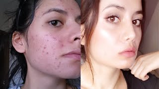 Tretinoin Before and After 12 Tips To Get The BEST RESULTS [upl. by Inneg784]