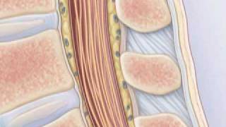 Comment pratiquer une ponction lombaire [upl. by Daryn]