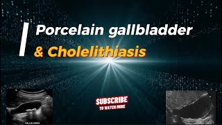 Porcelain gallbladder and cholelithiasis ultrasound gallbladder echography cholelithiasis [upl. by Reaht]