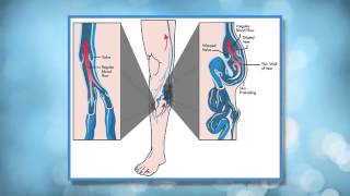 Comprehensive Overview of Leg Swelling by Chris Meyer MD [upl. by Hephzibah907]