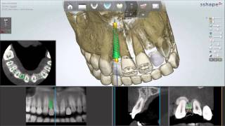 Dental System 2013  Implant Planning and Guided Surgery [upl. by Amikehs94]