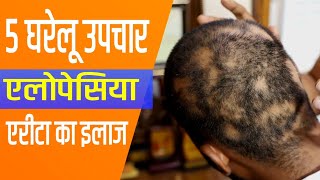 5 Home Remedies for Alopecia Areata Treatment of Alopecia Areata [upl. by Audsley]