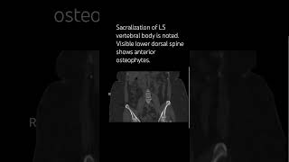 Sacralization of L5 vertebral body is noted spinesurgeon neurosurgeon orthopedicsurgeon [upl. by Attenwahs]