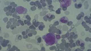 Hematology Bone Marrow Hemoblastosis [upl. by Yeltneb]