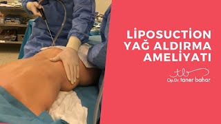 Liposakşın  Liposuction Yağ Aldırma Ameliyatı  OpDrTaner Bahar [upl. by Nelhsa355]