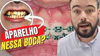 POSSO COLOCAR APARELHO SEM LIMPEZA CAFÉ COM O DENTISTA [upl. by Cynar]