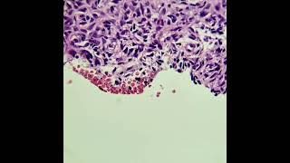 Dermatofibroma aneurismático e com hemossiderina [upl. by Dnalwor]