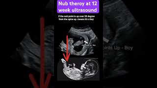 Guess the gender with Nub theory Baby boy or girl pregnancy ultrasound pregnancycare [upl. by Amo]