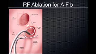 Pulmonary Vein Ablation Cardiac CT [upl. by Alvina]