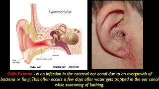 Otitis Externa PEV [upl. by Chi329]