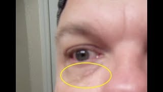 Getting Rid Face Skin Blemishes Naturally WATER FASTING Day 18 Xanthelasma yellow bumps under eyes [upl. by Forster]